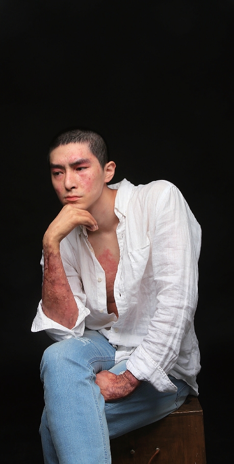 K9 자주포 사고로 큰 부상을 당한 이찬호 예비역 병장(25). 사고 이후의 자신의 치유 과정을 사진으로 기록한 모습들. 이 사진들은 화상환자들 뿐 아니라 장애인 등을 위한 사진전 및 책 출간에 사용될 예정이다.(사진: 이찬호 제공)
