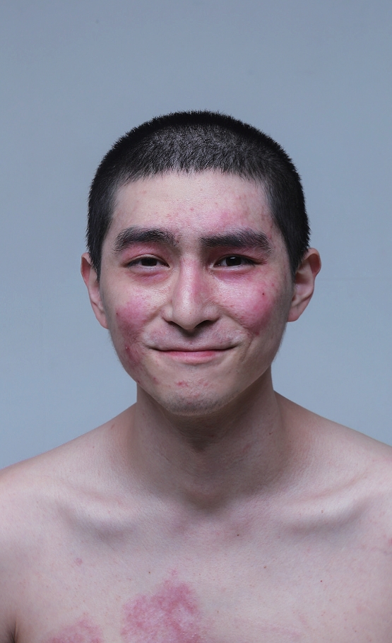 K9 자주포 사고로 큰 부상을 당한 이찬호 예비역 병장(25). 사고 이후의 자신의 치유 과정을 사진으로 기록한 모습들. 이 사진들은 화상환자들 뿐 아니라 장애인 등을 위한 사진전 및 책 출간에 사용될 예정이다.(사진: 이찬호 제공)