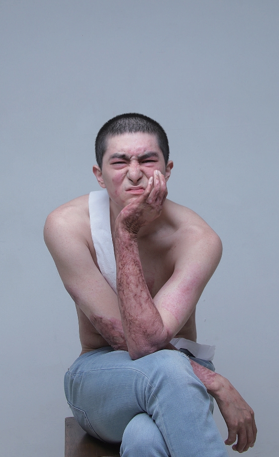 K9 자주포 사고로 큰 부상을 당한 이찬호 예비역 병장(25). 사고 이후의 자신의 치유 과정을 사진으로 기록한 모습들. 이 사진들은 화상환자들 뿐 아니라 장애인 등을 위한 사진전 및 책 출간에 사용될 예정이다.(사진: 이찬호 제공)