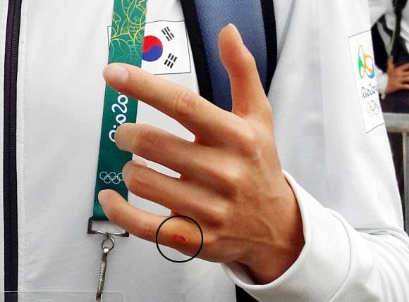 역주행 선수와 부딪쳐 손가락 찰과상
