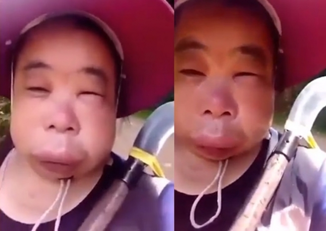 벌에 쏘여 얼굴이 부어오른 여성 벌에 쏘여 얼굴이 부어오른 여성