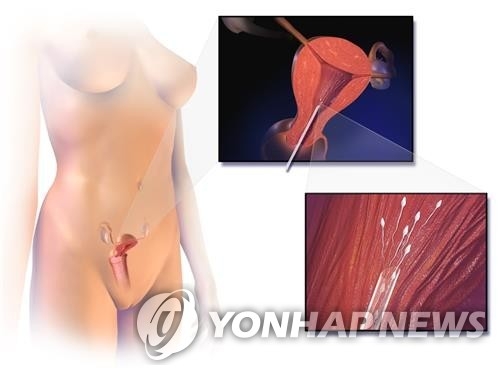 인공수정 자료사진. 연합뉴스