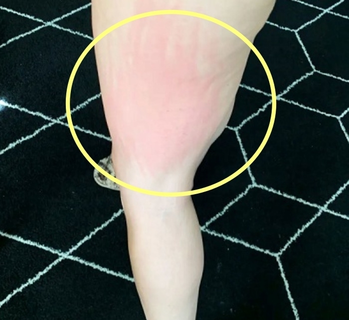 정액 알레르기(Semen allergy)를 겪고 있어 성생활이 고통스럽다는 앨리슨 테니슨(34)의 사연이 전해졌다. 정액 알레르기로 인해 빨갛게 부은 앨리슨 테니슨의 다리. ‘더 선’ SNS 캡처