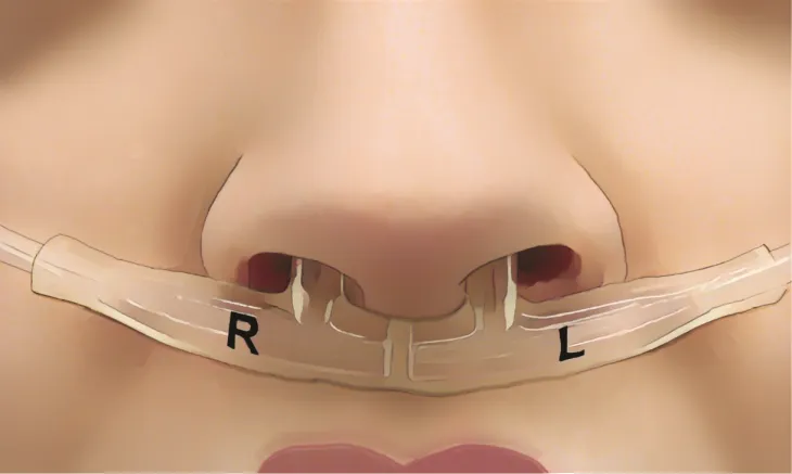 비강 호흡 패턴은 지문처럼 사람마다 다르다는 사실이 밝혀졌다. 또 비강 호흡 패턴은 신체적, 정신적 건강과 밀접한 관계가 있는 것으로 나타났다. 비강 호흡 패턴을 측정하는 장치 이스라엘 바이츠만 과학연구소 제공 비강 호흡 패턴은 지문처럼 사람마다 다르다는 사실이 밝혀졌다. 또 비강 호흡 패턴은 신체적, 정신적 건강과 밀접한 관계가 있는 것으로 나타났다. 비강 호흡 패턴을 측정하는 장치 이스라엘 바이츠만 과학연구소 제공